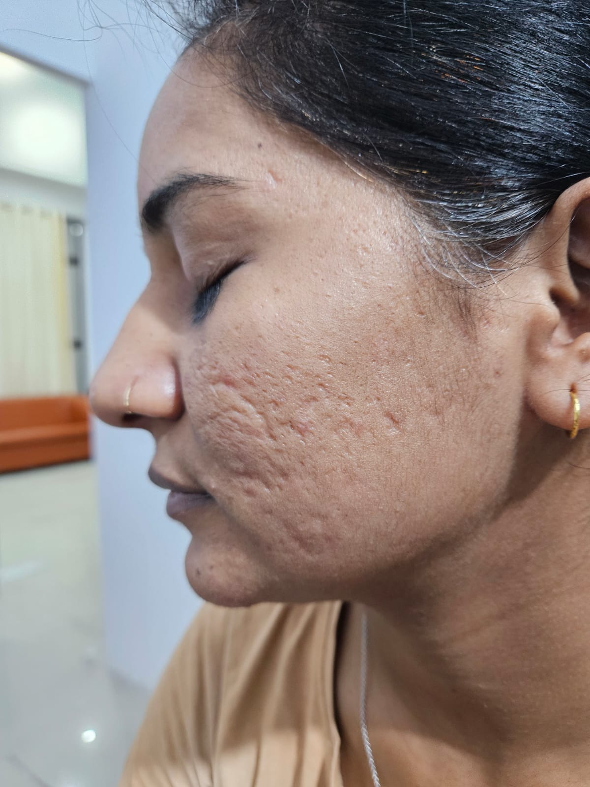 skin-treatment